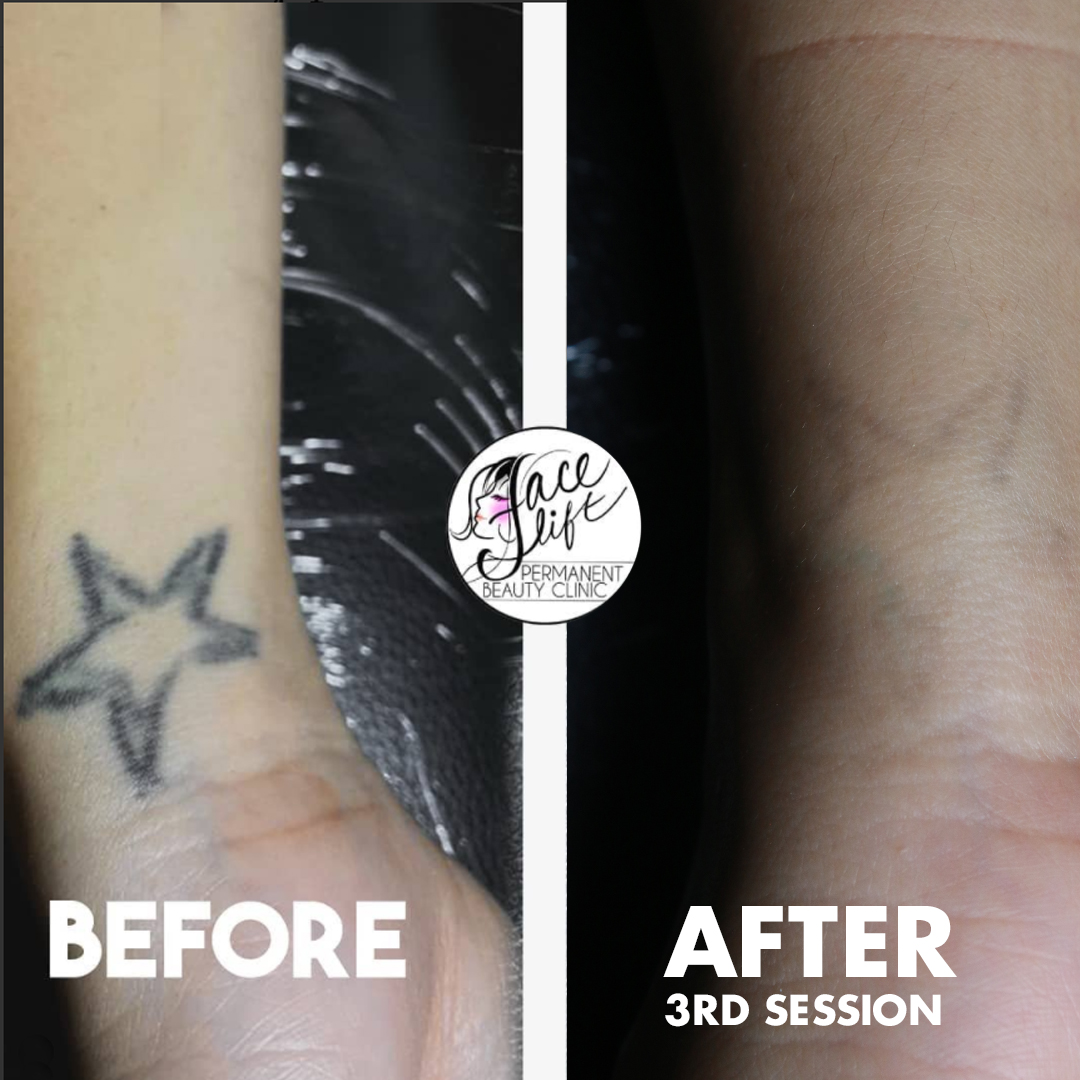 Learn 99+ about permanent tattoo removal cost best .vn