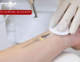 Kolkata Tattoo Removal: Essential Summer Aftercare
