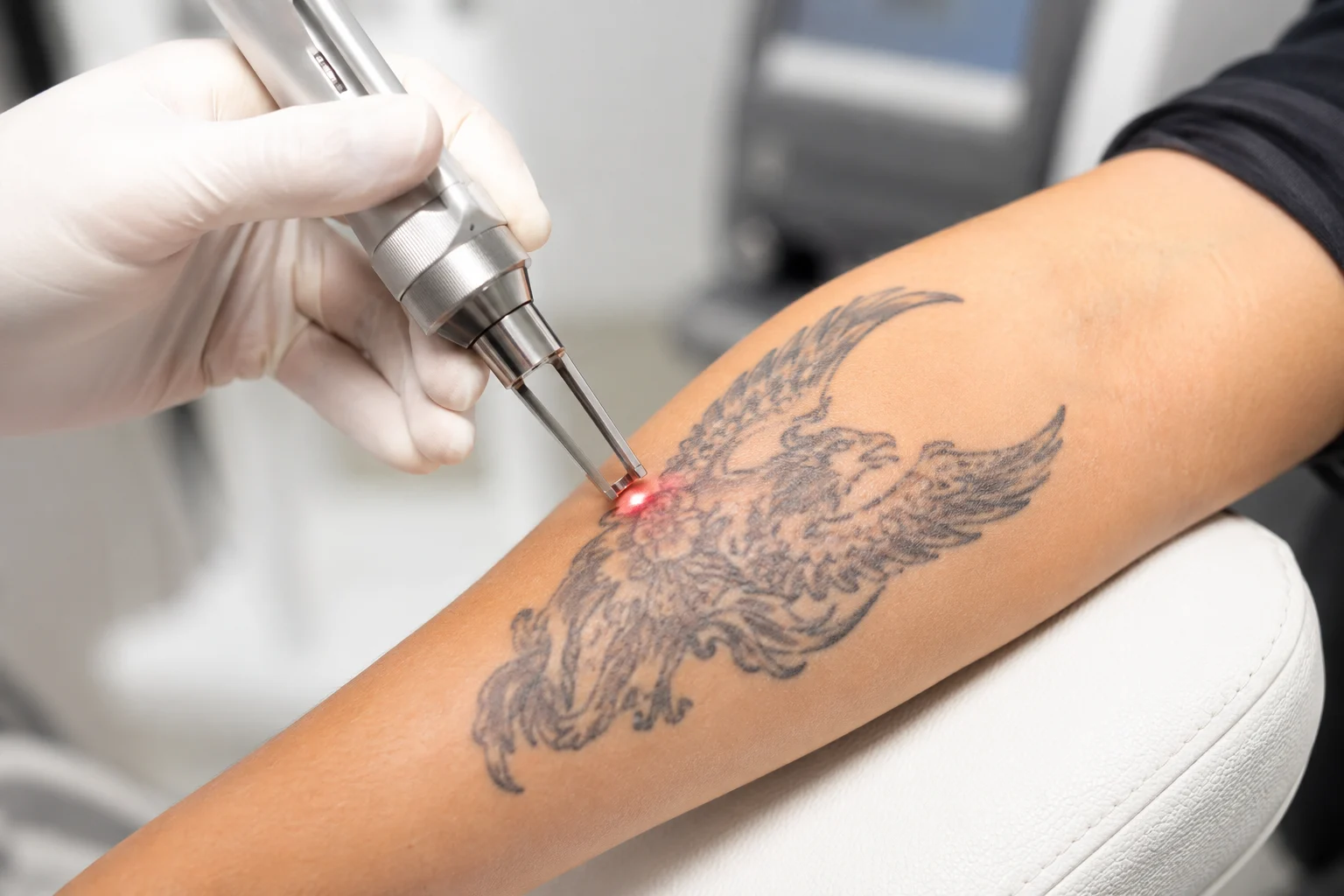 tattoo removal in kolkata