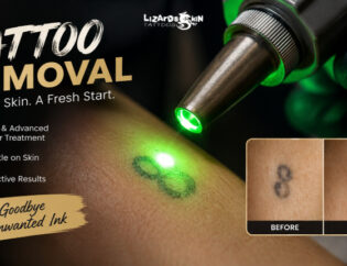 Safe Laser Treatment