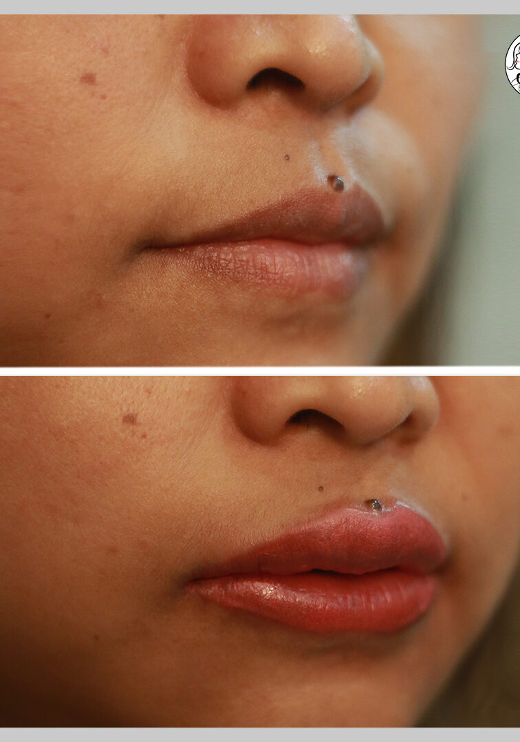 LIP CORRECTION FL