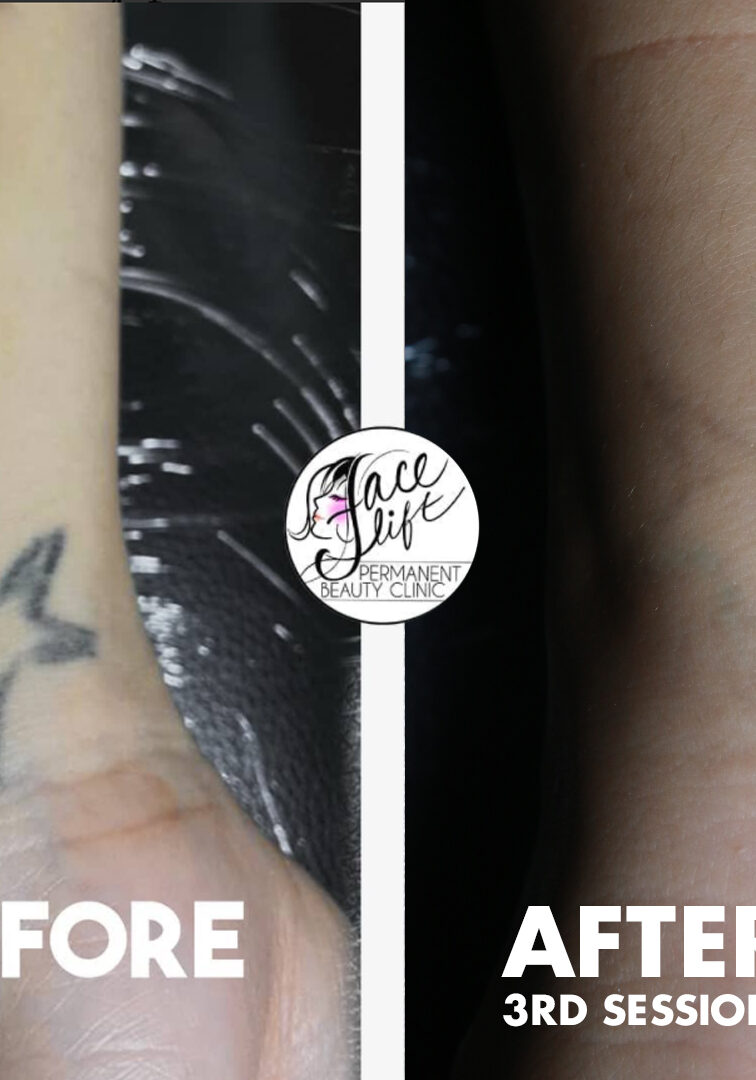 best laser tattoo removal clinic in kolkata